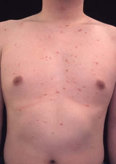 粃 と 糠 は 🐲ジベル 薔薇色 ジベルばら色粃糠疹の原因、症状、治療 再発する？予防できる？｜アスクドクターズトピックス